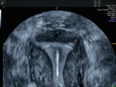 Image Echographie 3D du positionnement du DIU
